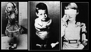 Children of Thalidomide with artificial limbs.